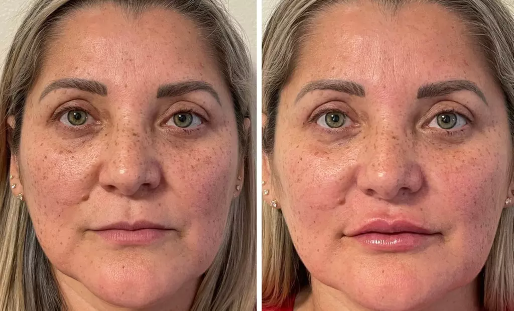 Unleash Your Glow: Transform Wrinkles with Dysport Magic!