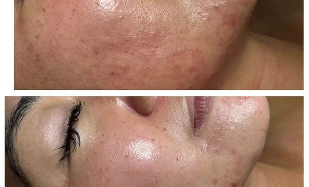 Revitalize Your Skin with 30 or 60-Minute Chemical Peels