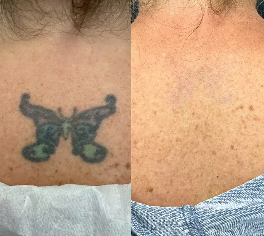 Up to 60% Off on Tattoo Removal at Elixir Beauty Clinic - Primary Image