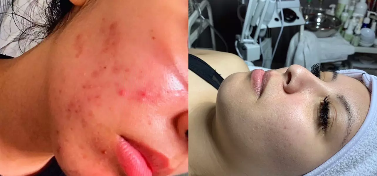 Discover Morris Code Beauty's acne treatment consultation with personalized care, offering solutions up to 50% off - Primary Image