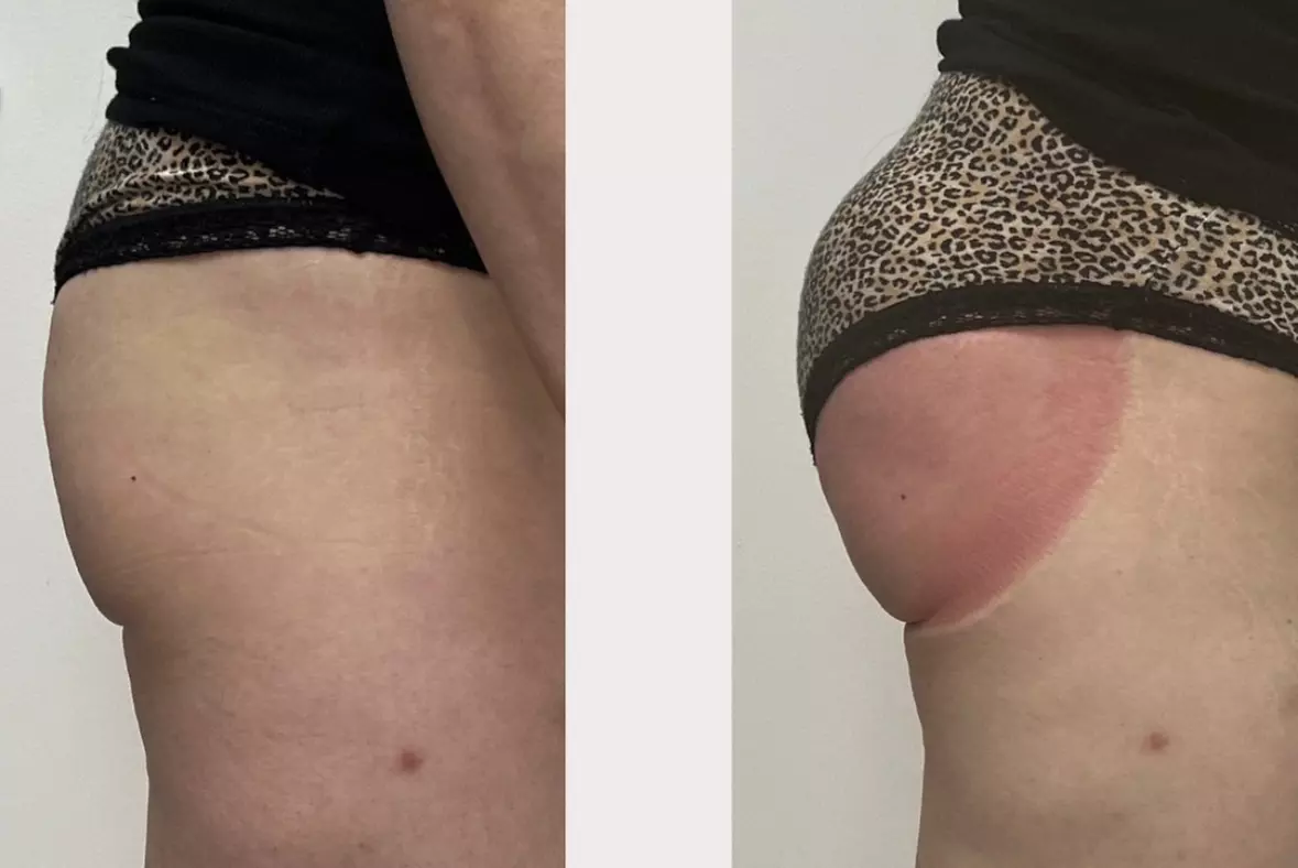 Up to 50% Off on Non invasive Brazilian Butt Lift Treatment at Arched by Amaris