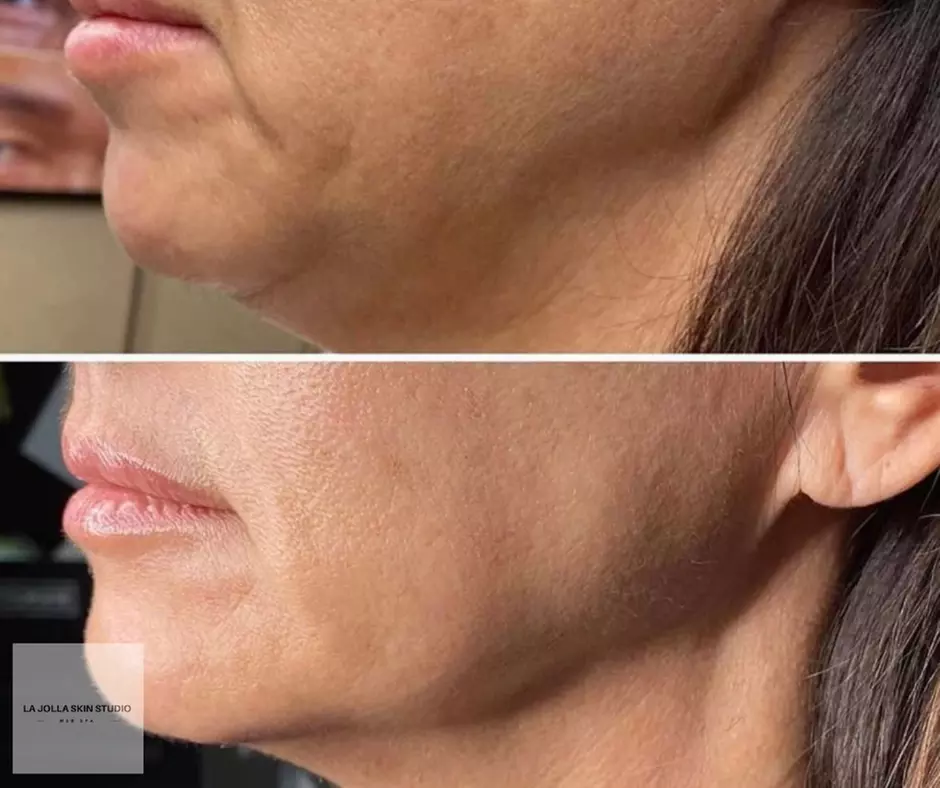 Up to 61% Off on Anti-Aging Facial at La Jolla Skin Studio - Second Medium