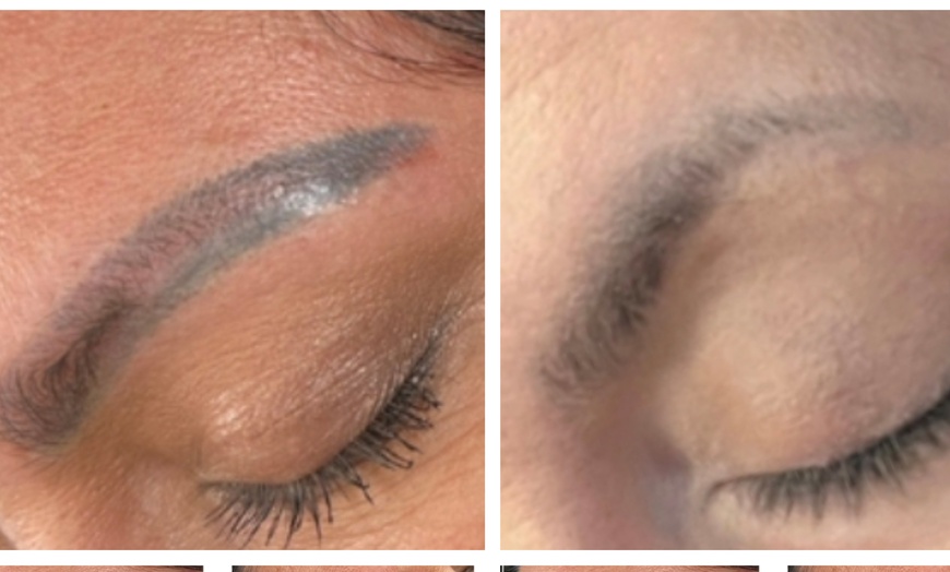 Image 1: Permanent Makeup Removal Kit with Free Microblading Training