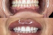 Up to 15% Off on Teeth Whitening at Pearl Glow Smiles - Second Medium