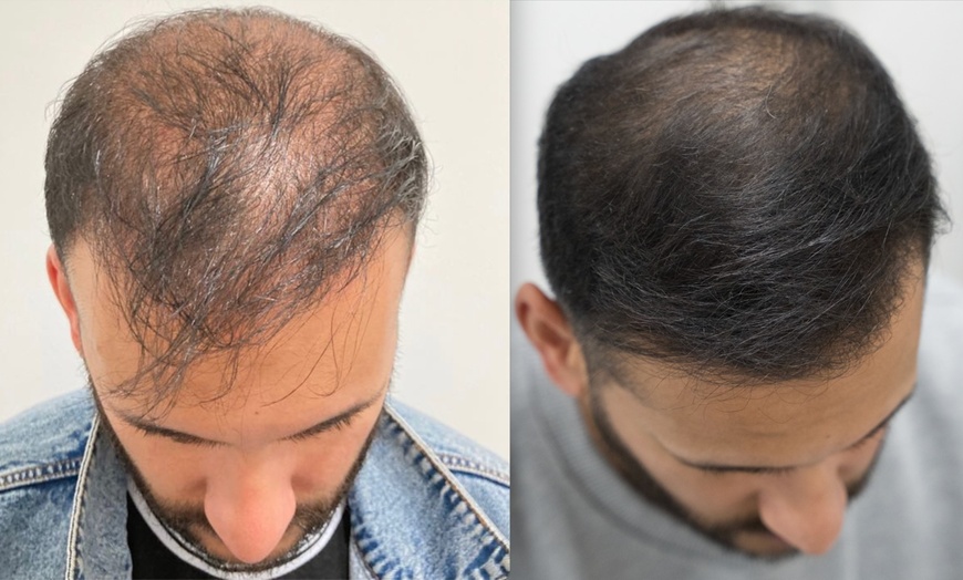 Image 7: Up to 58% Off on Salon - Hair Straightening Treatment at UK Aesthetics Lounge