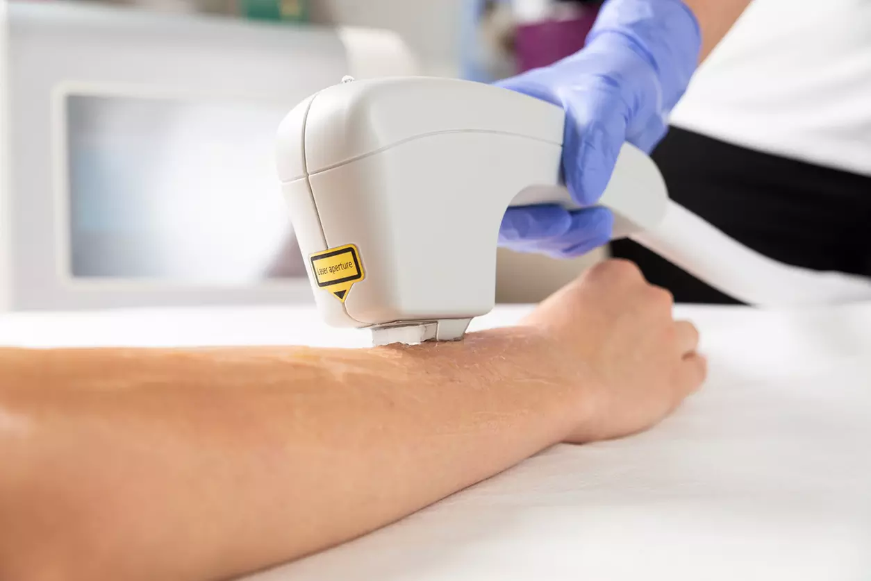 IPL Therapy for Arms & Hands or Legs Skin Rejuvenation