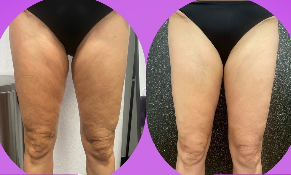 Tailored Body Sculpting: Ultra Slim 360, & More by Certified Experts