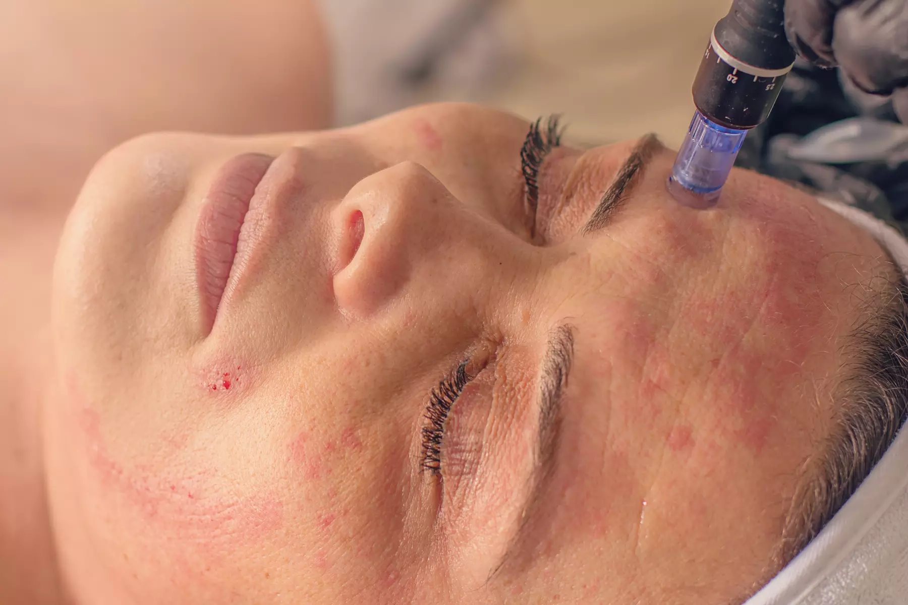 Experience Brows Are Us: Microneedling Therapy, Scalp Session & More with up to 60% Off - Primary Image