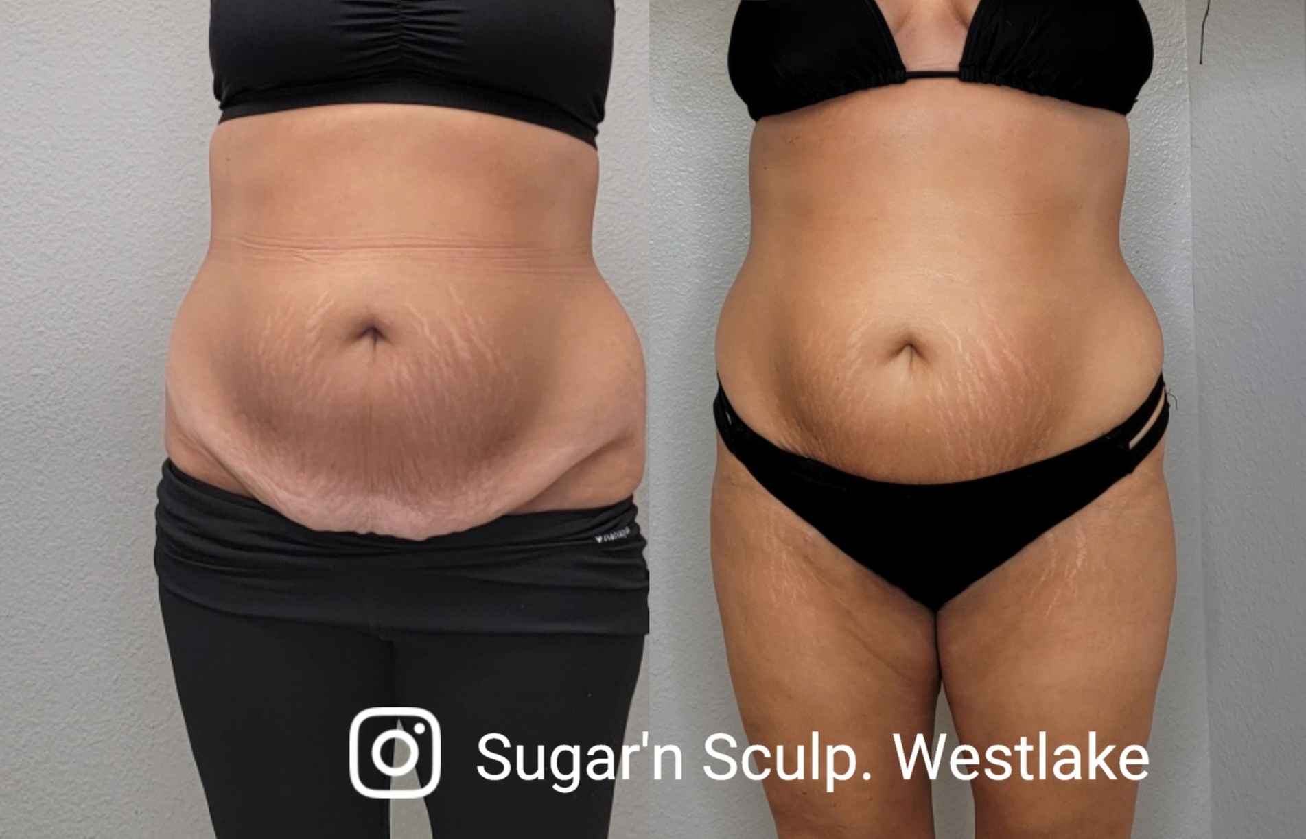 The Ultimate Body Sculpting Experience at Sugar'n Sculpt Westlake

