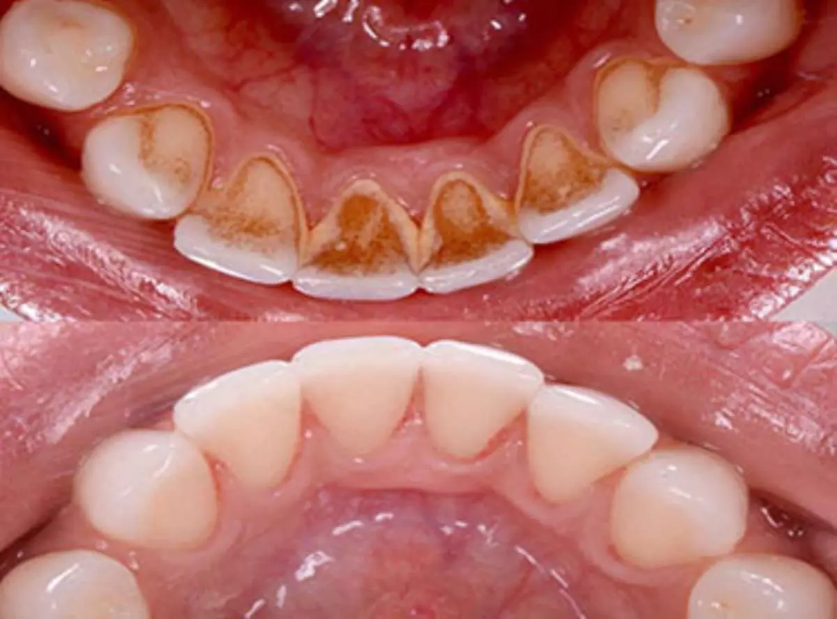 Achieve a Brighter Smile with Milpitas Square Dental's Crown and Cleaning Services, Up to 50% Off - Primary Image