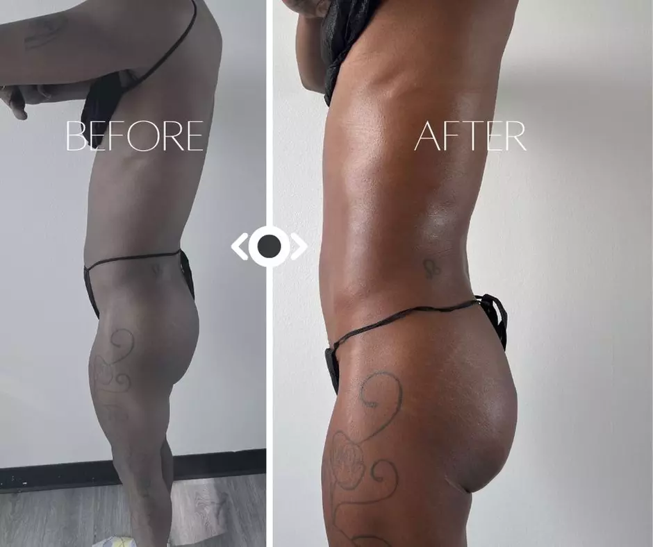 Up to 50% Off on Lipo - Non-Invasive Laser-iLipo at Body Please Sculpting - Second Medium