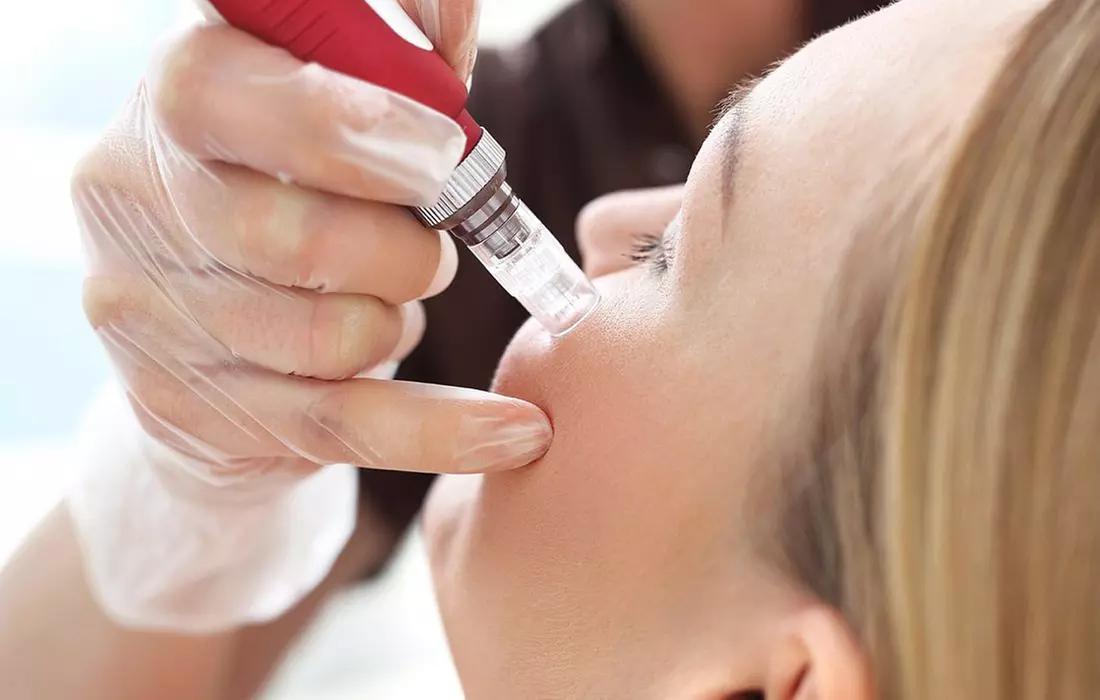 $120 for Microneedling and Anti-Aging Facial ($150 Value) - Primary Image