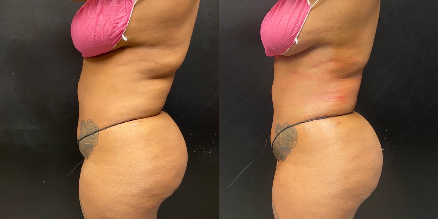 Up to 30% Off on Lipo - Non-Invasive Laser-iLipo at Better Looks Body Contour