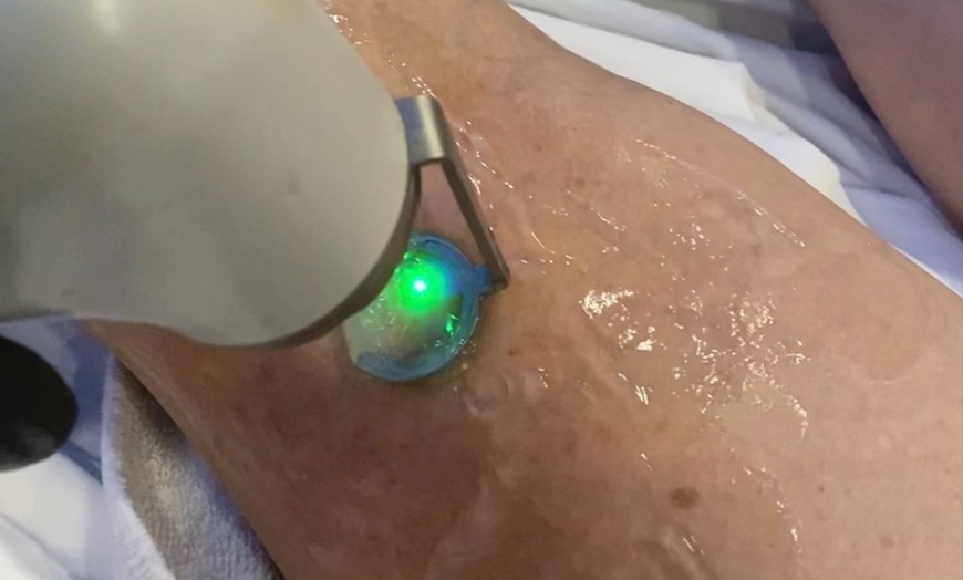 Image 1: Reveal Smooth, Youthful Skin: One, Two or Three Laser Spider-Vein Removal Sessions at Loma Laser - Up to 67% Off