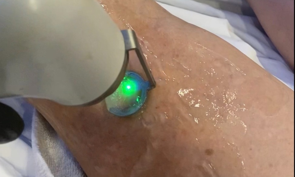 Reveal Smooth, Youthful Skin: One, Two or Three Laser Spider-Vein Removal Sessions at Loma Laser - Up to 67% Off