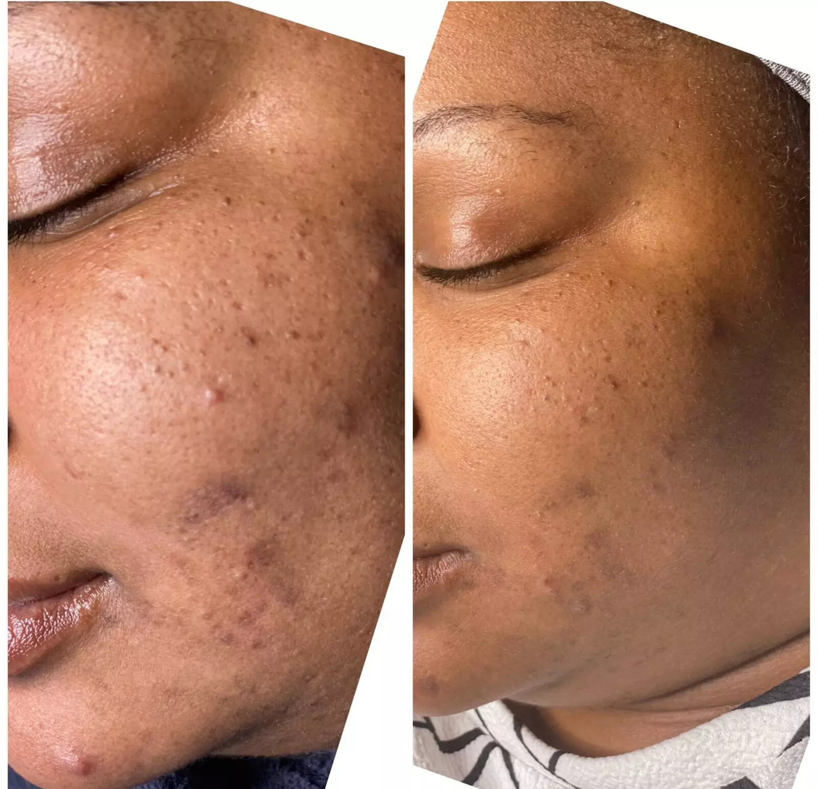 BioRePeel Facial: Reveal Glowing Skin