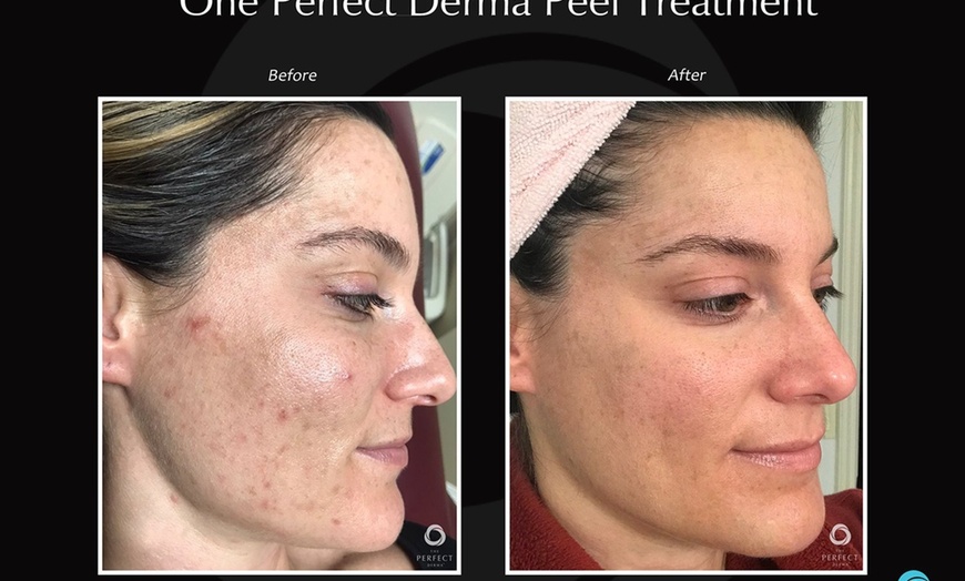 Image 2: Revitalize with the Perfect Derma Peel Treatment For Smooth Skin 