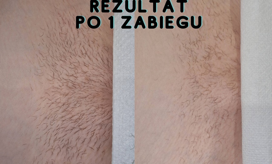 Image 5: Do 40% zniżki na: Depilacja laserowa w DS Beauty