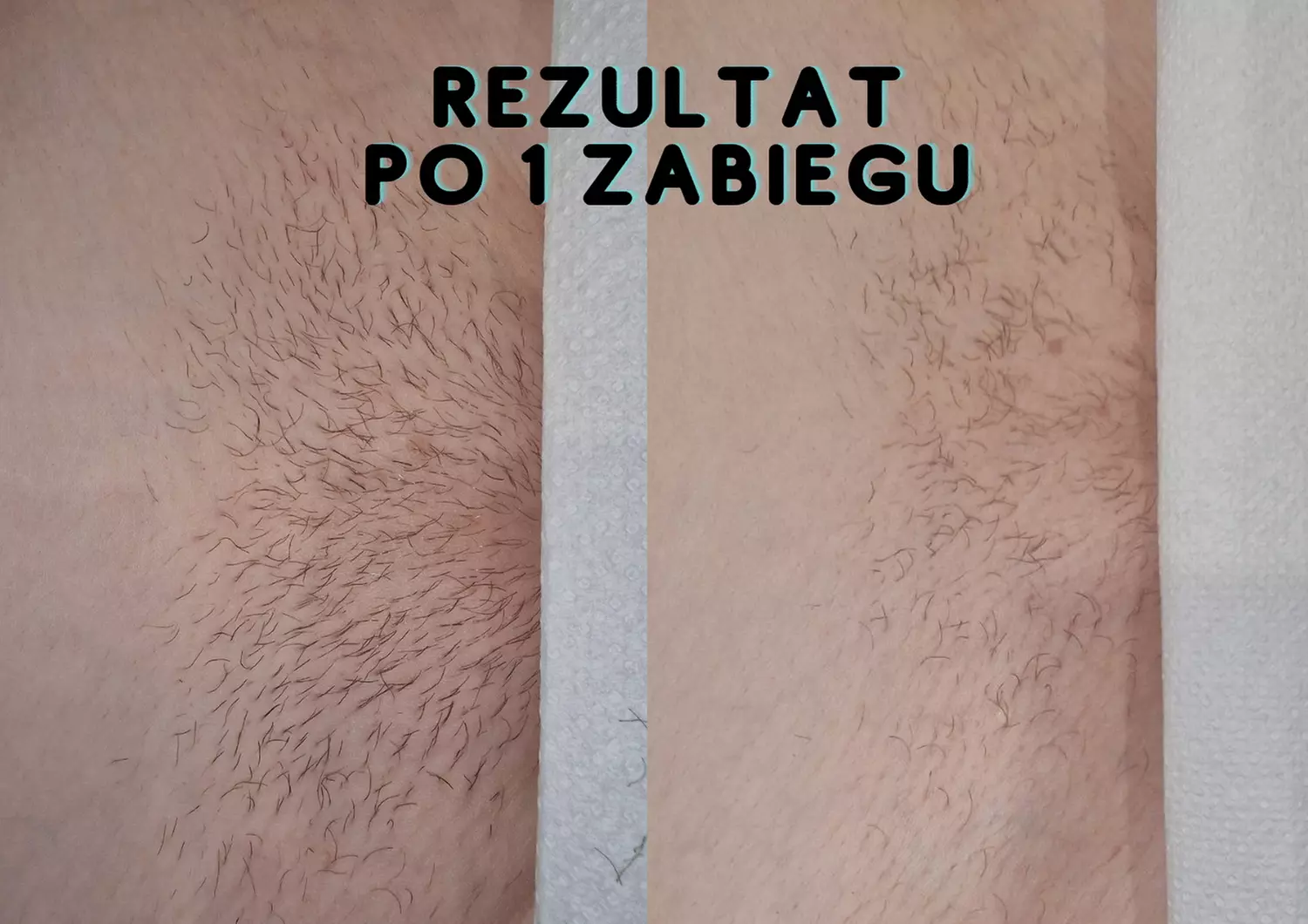 Depilacja laserowa wybranych partii ciała dla kobiet i mężczyzn