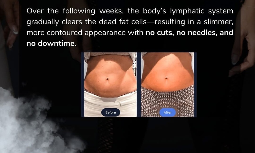 Image 5: Cryoslimming for Stubborn Abdominal Fat: No Surgery, No Downtime
