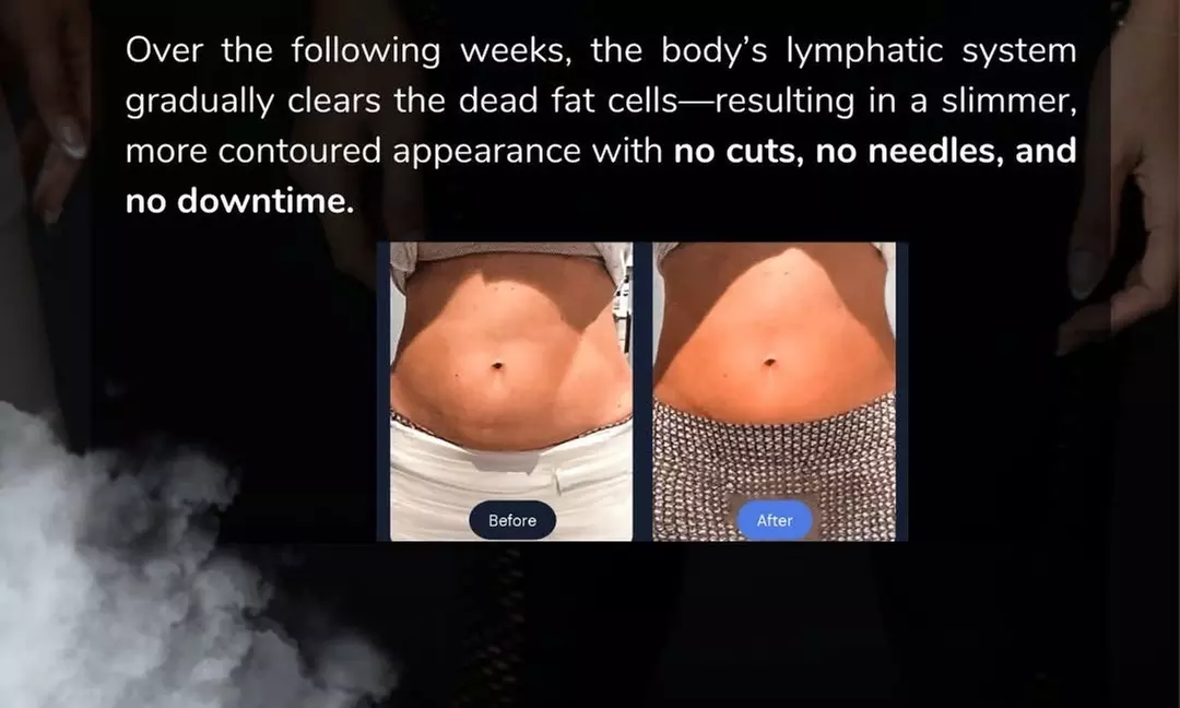 Cryoslimming for Stubborn Abdominal Fat: No Surgery, No Downtime