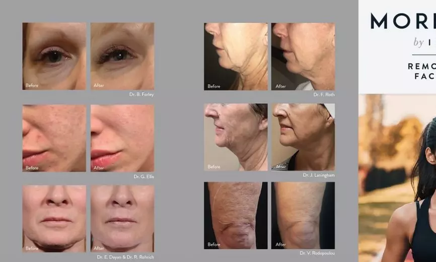 Up to 85% Off on Radio Frequency Skin Tightening at LuxSpa & Wellness - Primary Image