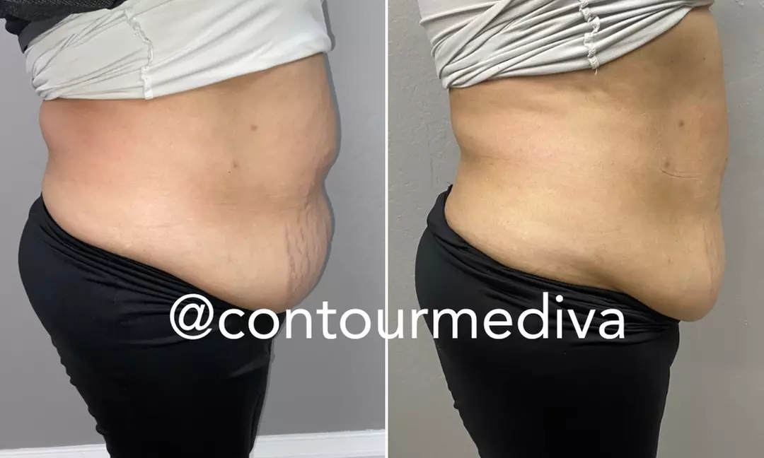 Up to 50% Off on Ultrasonic Fat Reduction at Contour me diva