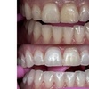 Image 5: Up to 30% Off on Teeth Whitening at Glow Beaute