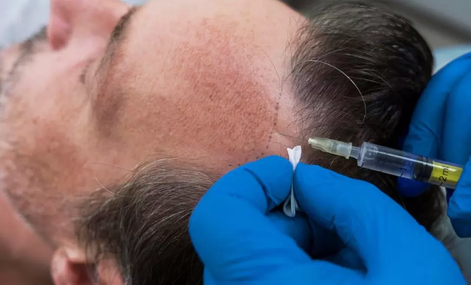 1 o 2 sesiones de mesoterapia facial o capilar con revisión incluida