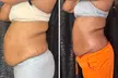 Up to 37% Off on Cavitation at Extreme body sculpting - Second Medium