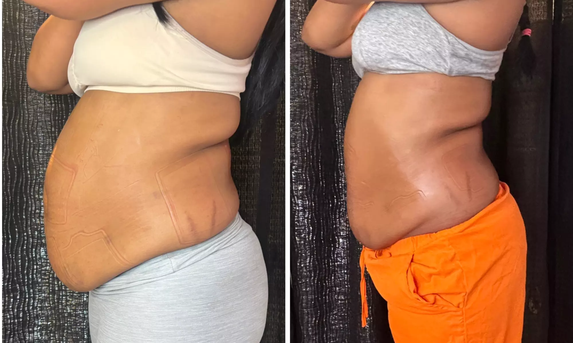 Up to 30% Off on Cavitation at Extreme body sculpting