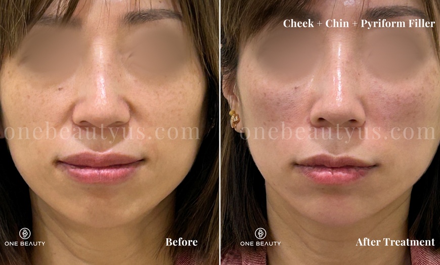 Image 7: Up to 52% Off on Injection - Dermal Filler at One Beauty Aesthetics