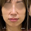 Image 7: Up to 52% Off on Injection - Dermal Filler at One Beauty Aesthetics