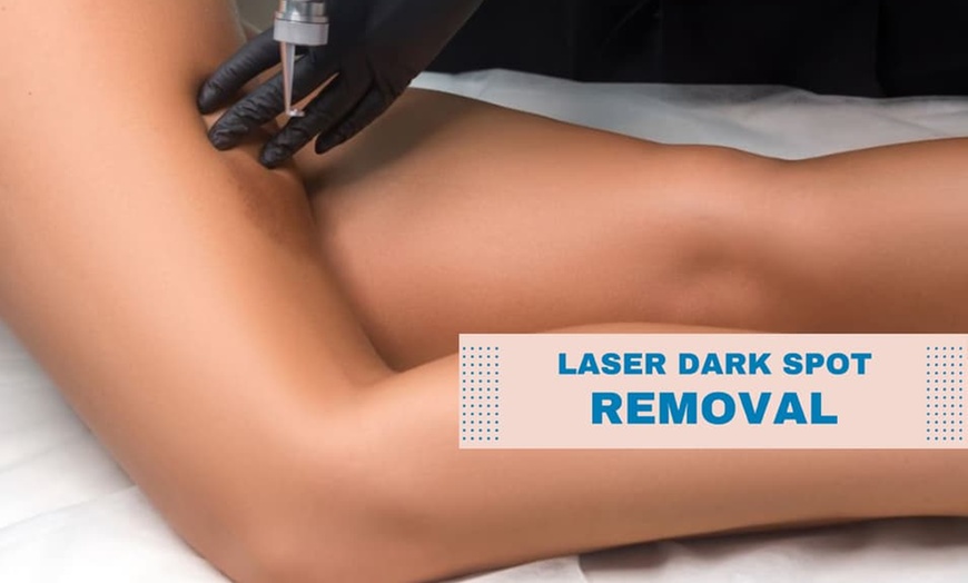 Image 2: Laser Dark Spot Removal Options for One Spot or 1, 3, or 6 Full Face