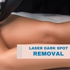 Image 2: Laser Dark Spot Removal Options for One Spot or 1, 3, or 6 Full Face