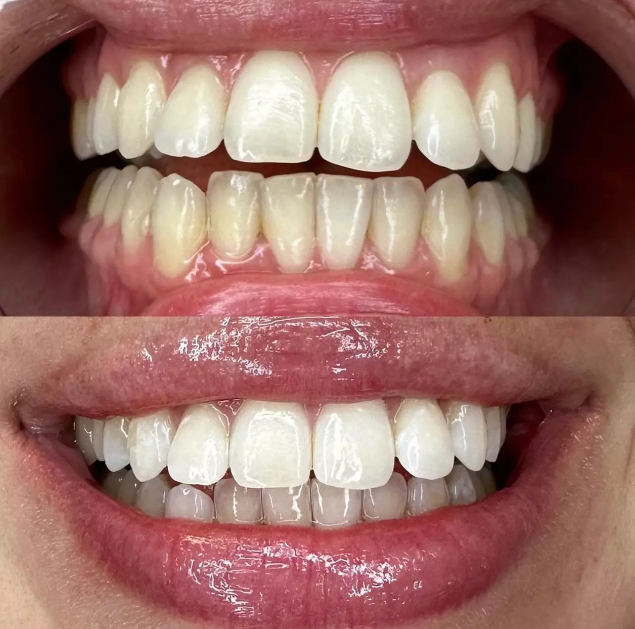 Up to 20% Off on Teeth Whitening at Changes Beaute Lounge - Second Medium