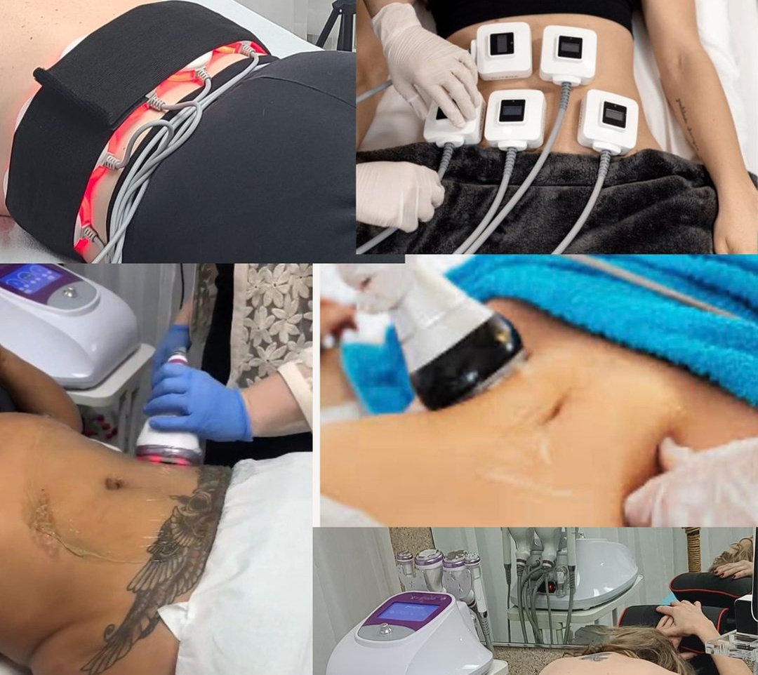 Shape Your Ideal Body with One or Four Sessions of Ultrasonic Cavitation, RF Treatment (Up to 50% Off) - Primary Image