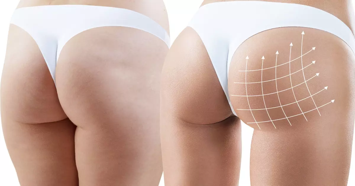 Discover B Fit Body Sculpting Inc's non-surgical butt lifts using Therma Lift with up to 88% off for a rejuvenated look - Primary Image