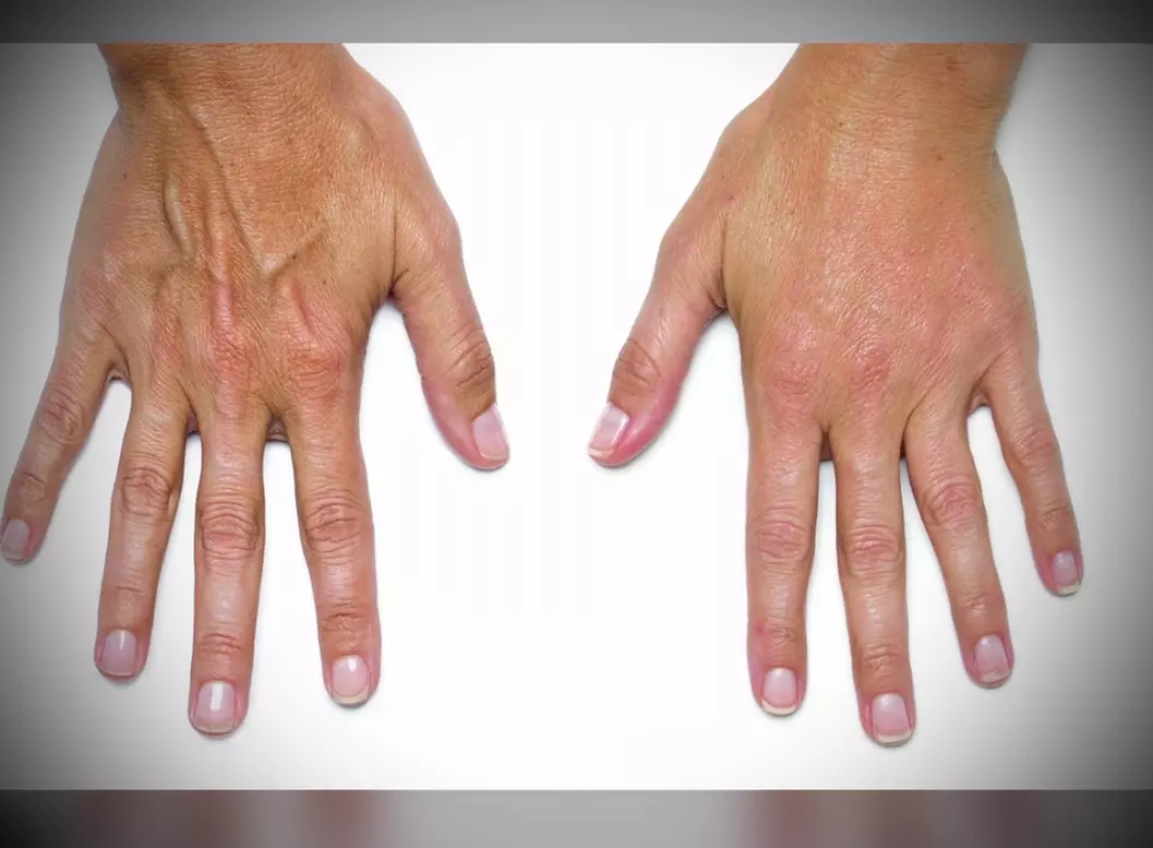 Odmładzająca pielęgnacja: RF lifting dłoni w Tatuaż & Beauty “Sorry Mom” (do -43%) - Image 3