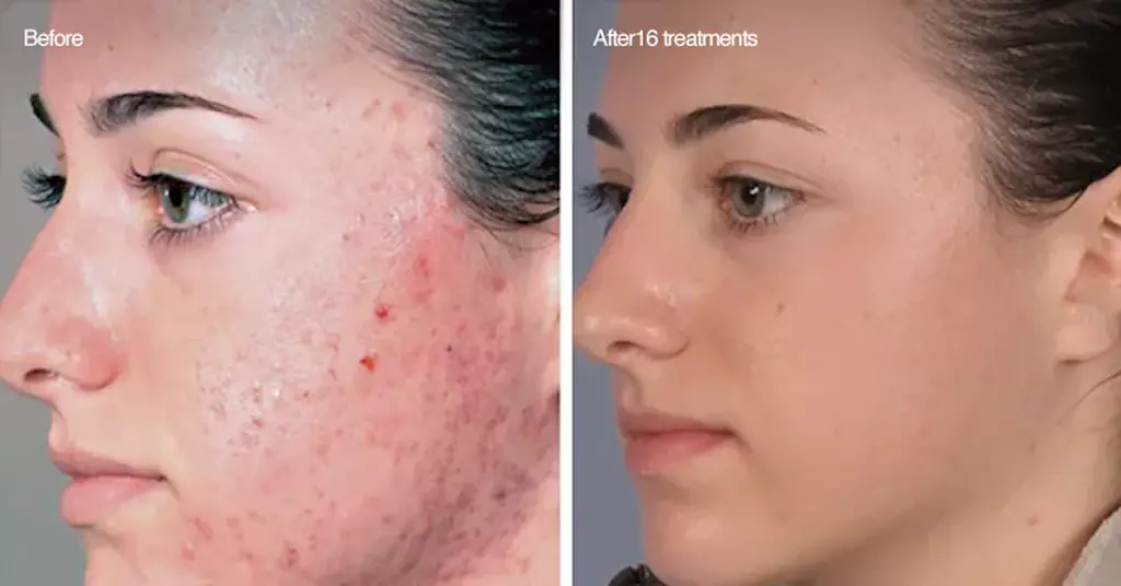 Up to 54% Off on Microdermabrasion at Derma Laser Spas - Second Medium