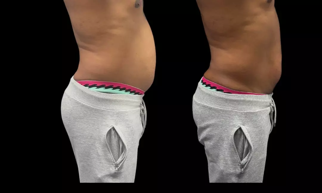 Experience Southern Shapez with ultrasonic fat reduction options and enjoy up to 56% off amazing sculpting sessions - Second Medium