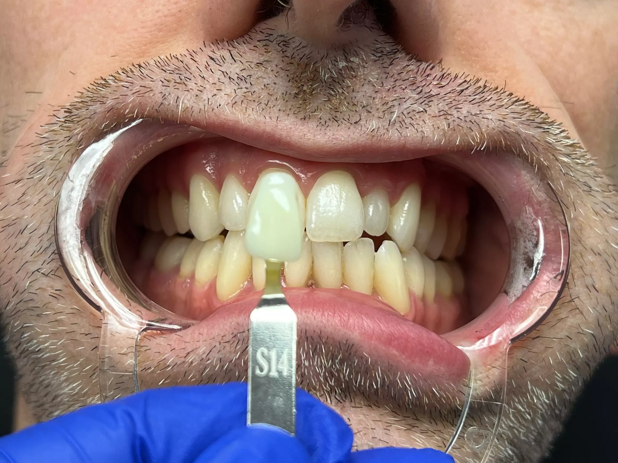 Up to 50% Off on Teeth Whitening - In-Office