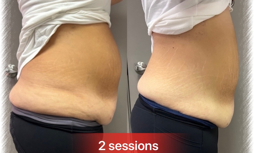 Image 2: Integusculpt RF Skin Tightening & Cavitation Treatment