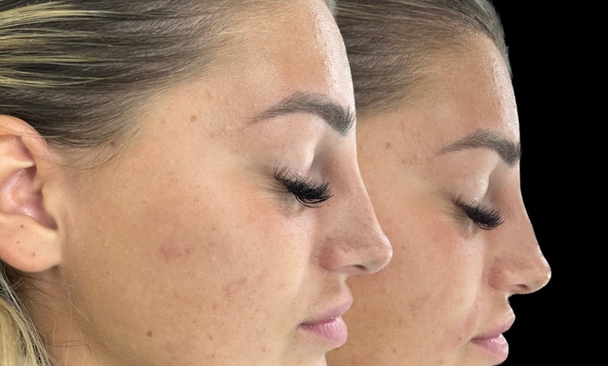 Image 3: Dermal Filler with Consultation at Shani Aesthetics