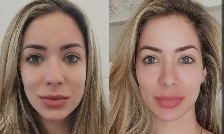 Up to 60% Off on Facial - HydraFacial at Fida Aesthetic - Aesthetic Boutique