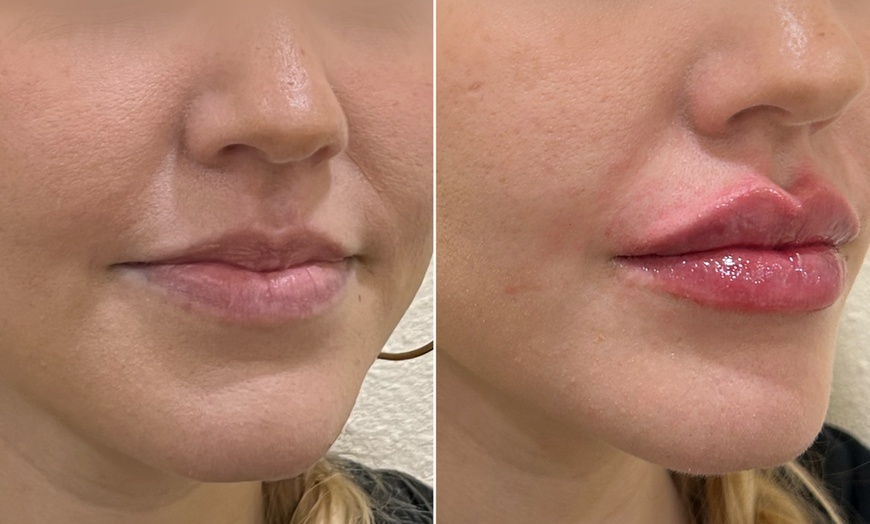 Image 1: Up to 50% Off on Injection - Voluma at One Beauty Aesthetics - Irvine