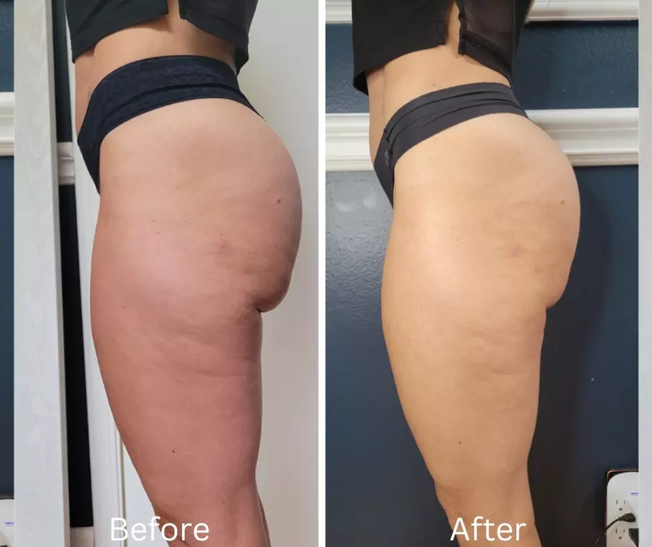Up to 66% Off on Weight Loss Program / Center at Berry Blonde Spa - Second Medium