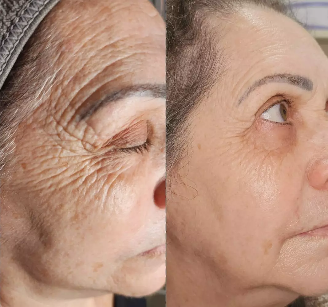 Up to 35% Off on Microdermabrasion at Rafa's Beauty Studio - Second Medium