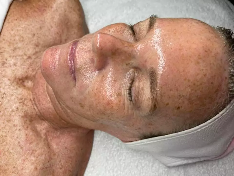 Up to 60% Off on Microdermabrasion at Bare Skinn Studio - Primary Image
