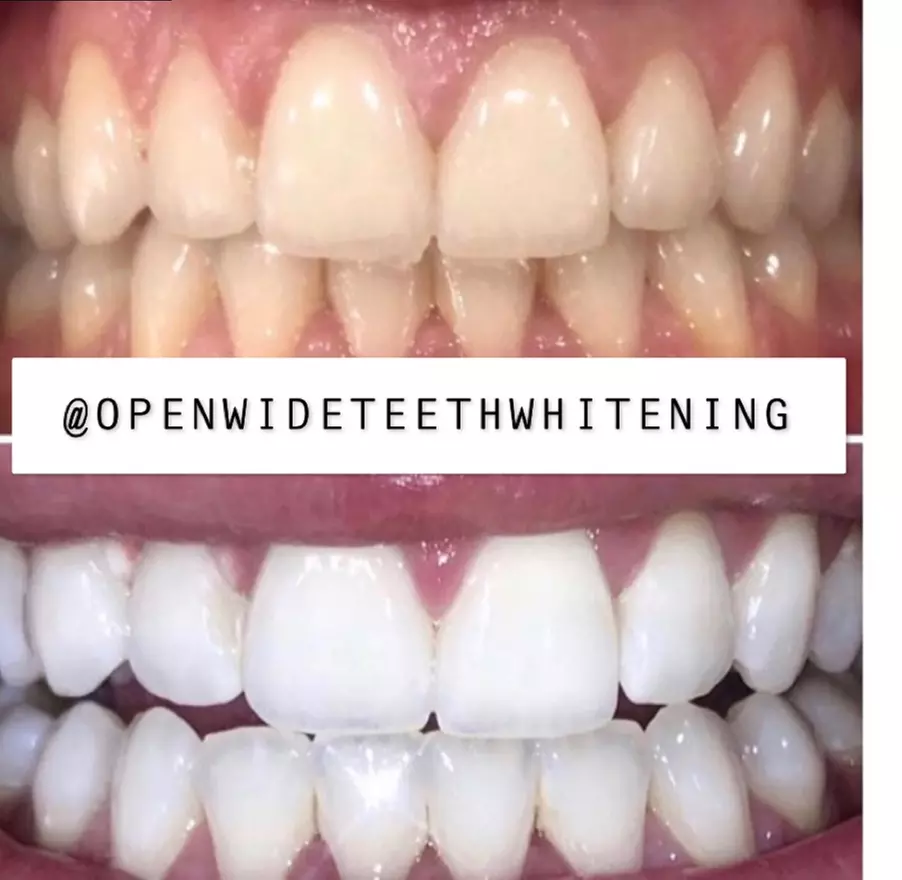 Up to 47% Off on Electronic - Beauty / Healthcare (Retail) at Open Wide Teeth Whitening - Primary Image